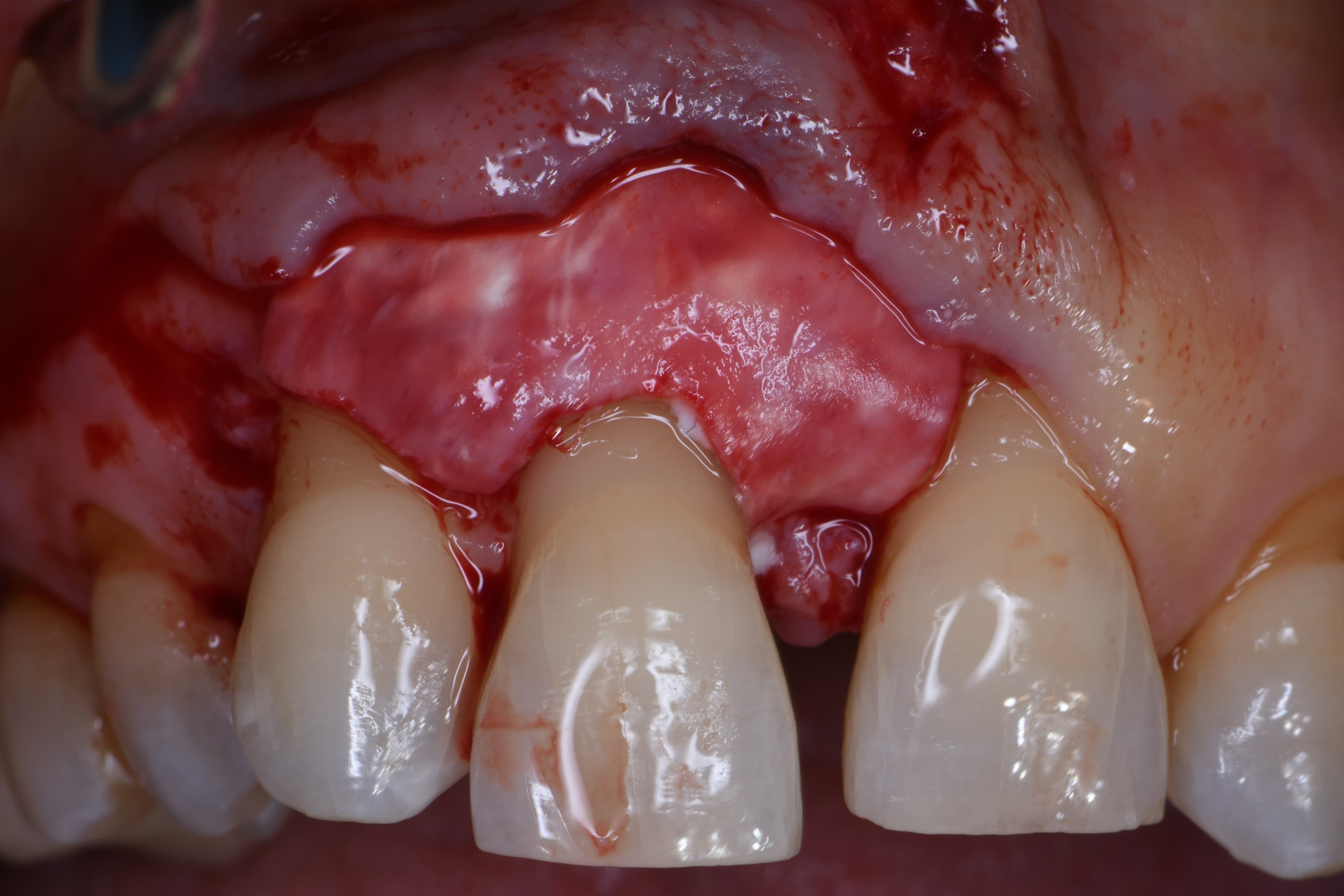 La Correzione Chirurgica del Difetto Parodontale