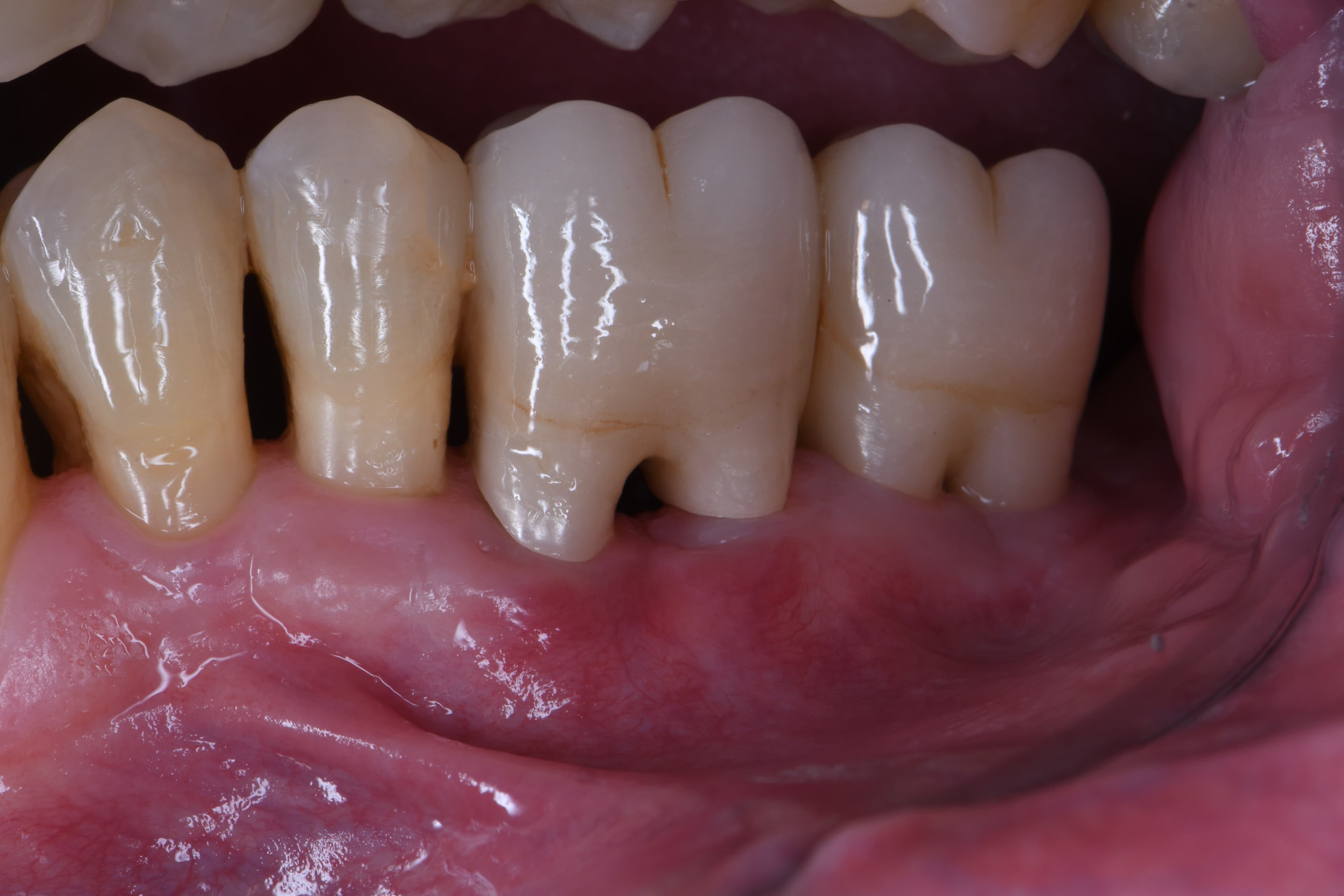 Aspetti Riabilitativi Perio-Protesico-Implantari