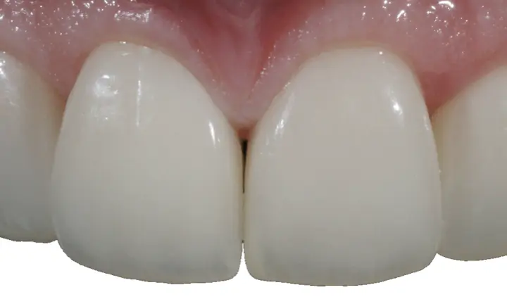 Le Riabilitazioni con Faccette in Ceramica
