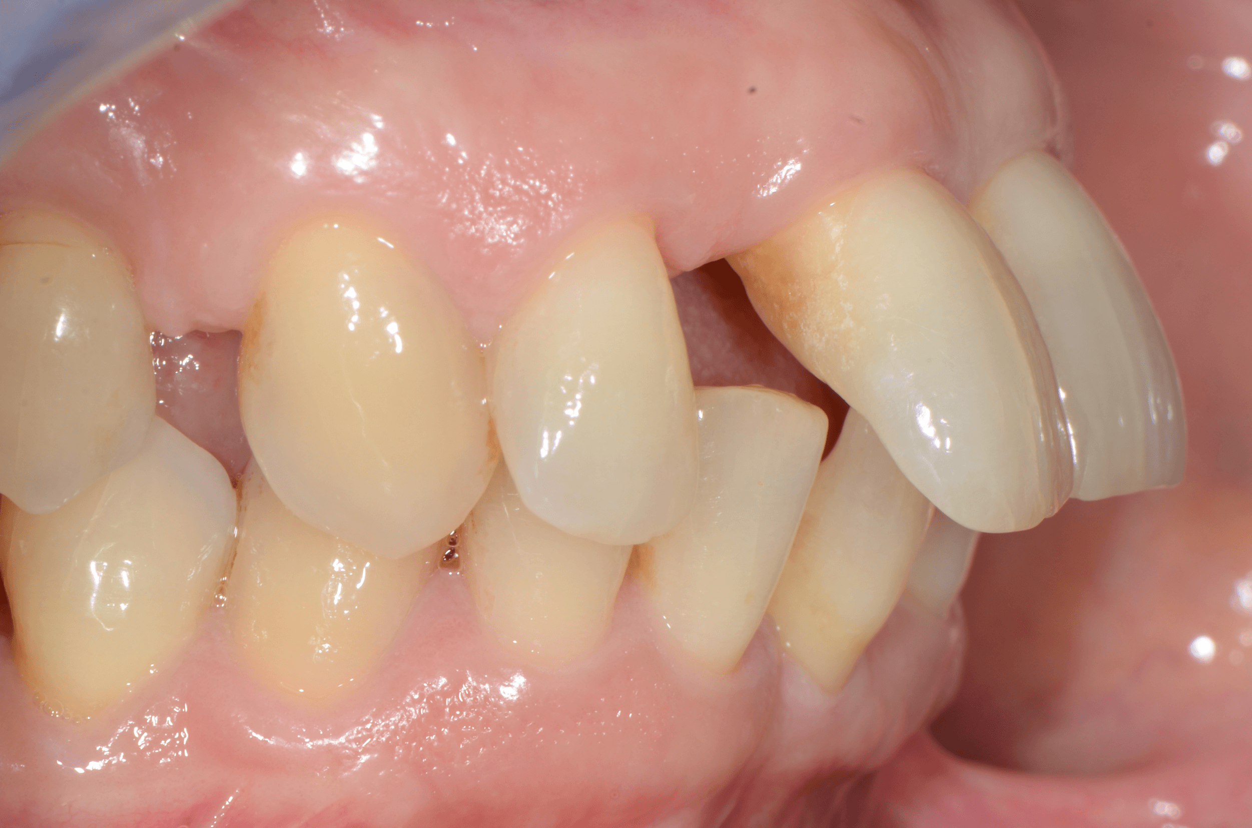 Soluzioni Riabilitative dei Pazienti di Stadio 4